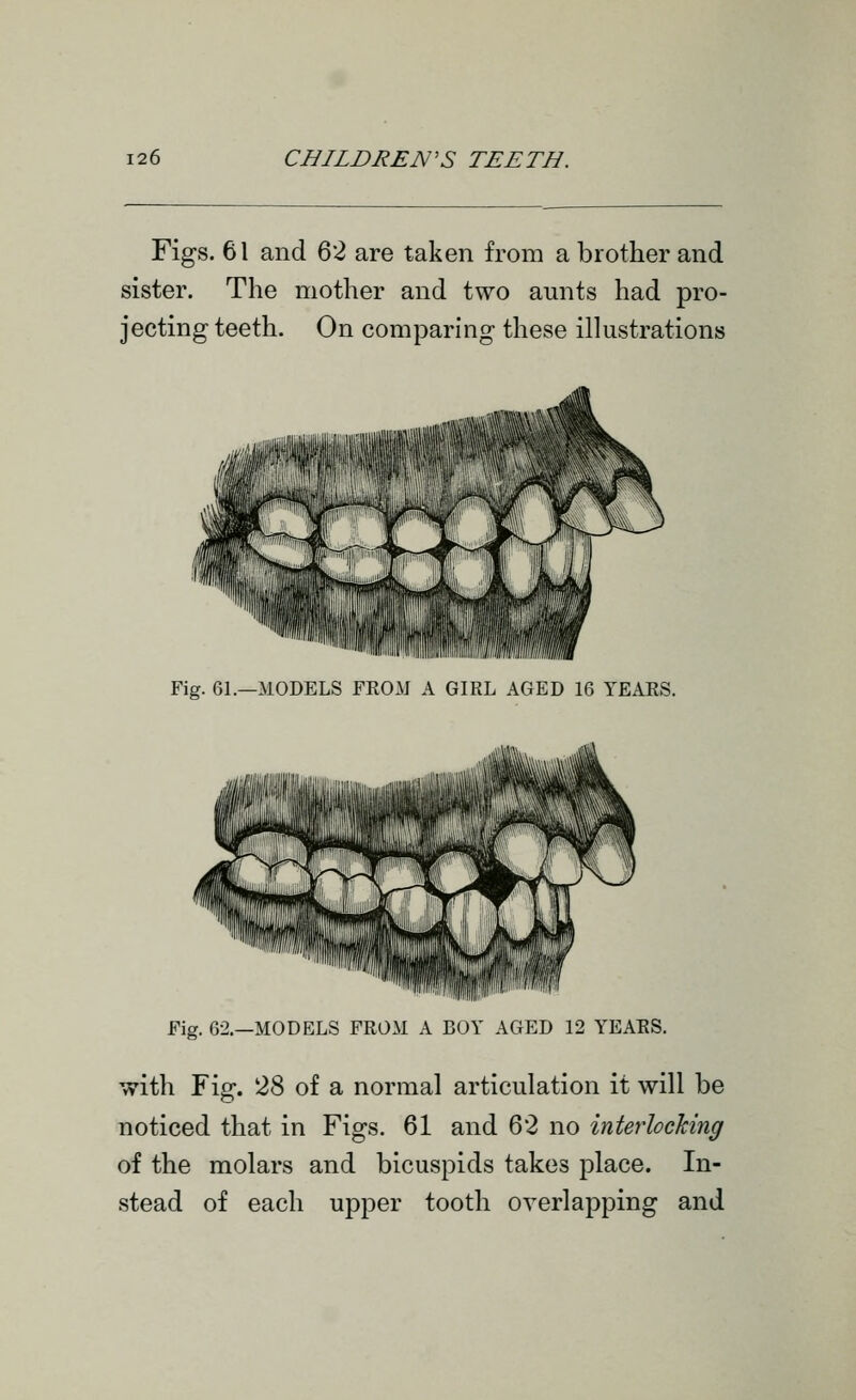 Figs. 61 and ^'l are taken from a brother and sister. The mother and two amits had pro- jecting teeth. On comparing these illustrations Fig. 61.—MODELS FEOM A GIRL AGED 16 YEARS. Fig. 62.—MODELS FROM A BOY AGED 12 YEAES. with Fig. 28 of a normal articulation it will be noticed that in Figs. 61 and 62 no interlocking of the molars and bicuspids takes place. In- stead of each upper tooth overlapping and