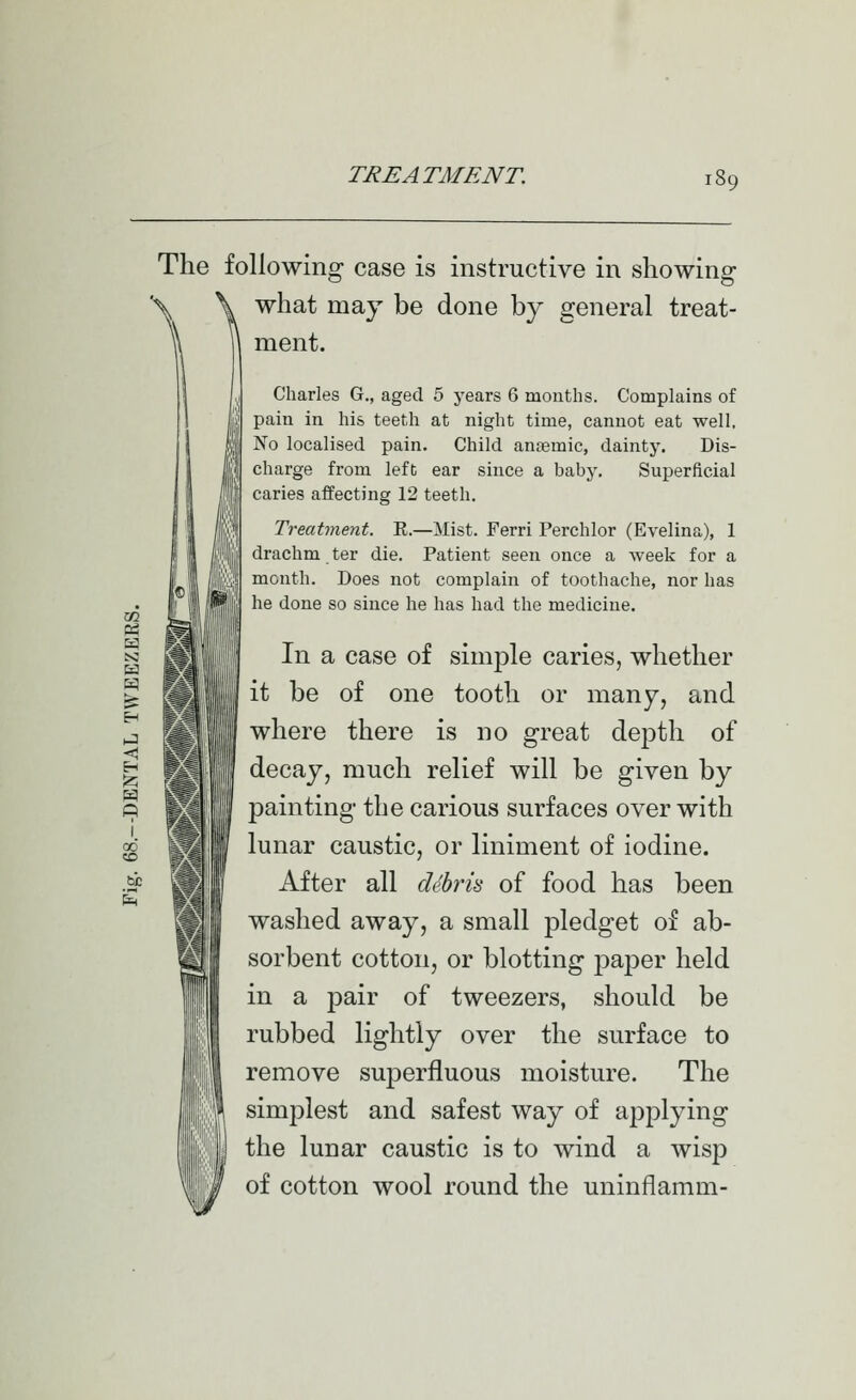 be The following case is instructive in showing \ \ what may be done by general treat- n n ment. Charles G., aged 5 years 6 months. Complains of pain in his teeth at night time, cannot eat well. No localised pain. Child antemic, dainty. Dis- charge from left ear since a baby. Superficial caries affecting 12 teeth. Treatment. E.—Mist. Ferri Perchlor (Evelina), 1 drachm ter die. Patient seen once a week for a month. Does not complain of toothache, nor has he done so since he has had the medicine. In a case of simple caries, whether it be of one tooth or many, and where there is no great depth of decay, much relief will be given by painting the carious surfaces over with lunar caustic, or liniment of iodine. After all dchrk of food has been washed away, a small pledget of ab- sorbent cotton, or blotting paper held in a pair of tweezers, should be rubbed lightly over the surface to remove superfluous moisture. The simplest and safest way of applying the lunar caustic is to wind a wisp of cotton wool round the uninflamm-