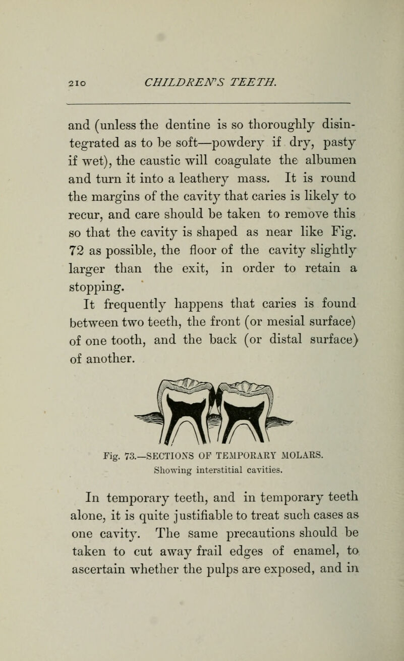 and (unless the dentine is so thoroughly disin- tegrated as to be soft—powdery if dry, pasty if wet), the caustic will coagulate the albumen and turn it into a leathery mass. It is round the margins of the cavity that caries is likely to recur, and care should be taken to remove this so that the cavit}^ is shaped as near like Fig. 72 as possible, the floor of the cavity slightly larger than the exit, in order to retain a stopping. It frequently happens that caries is found between two teeth, the front (or mesial surface) of one tooth, and the back (or distal surface) of another. Fig. 73.—SECTIONS OF TEMPORARY MOLARS. Showing interstitial cavities. In temporary teeth, and in temporary teeth alone, it is quite justifiable to treat such cases as one cavity. The same precautions should be taken to cut away frail edges of enamel, to ascertain w^hether the pulps are exposed, and in