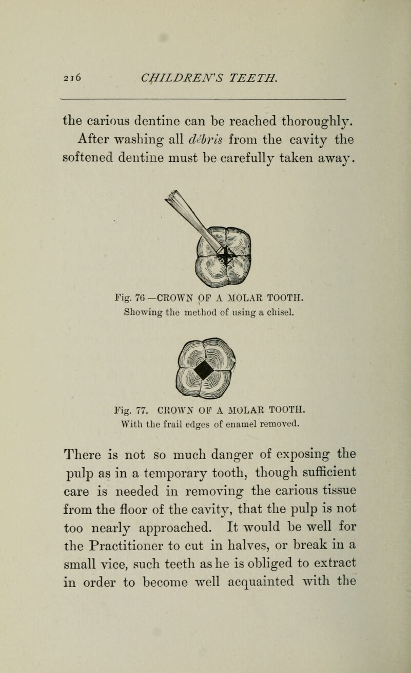 the carious dentine can be reached thoroughly. After washing all debris from the cavity the softened dentine must be carefully taken away. Fig. 76 —CROWN OF A MOLAR TOOTH. Showing the method of using a chisel. Fig. 77. CROAVN OF A MOLAR TOOTH. With the frail edges of enamel removed. There is not so much danger of exposing the pulp as in a temporary tooth, though sufficient care is needed in removing the carious tissue from the floor of the cavity, that the pulp is not too nearly approached. It would be well for the Practitioner to cut in halves, or break in a small vice, such teeth as he is obliged to extract in order to become well acquainted with the