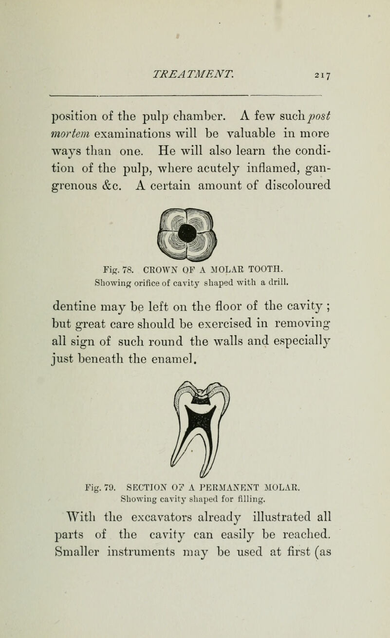 position of the pulp chamber. A few such/;os^ mortem examinations will be valuable in more ways than one. He will also learn the condi- tion of the pulp, where acutely inflamed, gan- grenous &c. A certain amount of discoloured Fig. 78. CROWN OF A :yJ0LAR TOOTH. Showing orifice of cavity shaped with a drill. dentine may be left on the floor of the cavity ; but great care should be exercised in removing all sign of such round the walls and especially just beneath the enamel. Fig. 79. SECTION 0? A PERMANENT MOLAR. Showing cavity shaped for filling. With the excavators already illustrated all parts of the cavity can easily be reached. Smaller instruments may be used at first (as