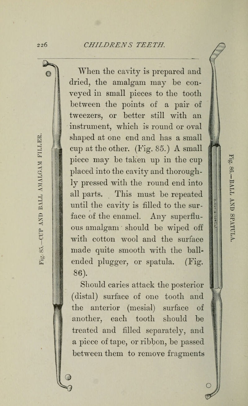 AVhen the cavity is prepared and dried, the amalgam may be con- veyed in small pieces to the tooth between the points of a pair of tweezers, or better still with an instrument, which is romid or oval shaped at one end and has a small cup at the other. (Fig. 85.) A small piece may be taken up in the cup placed into the ca^-ity and thorough- ly pressed with the round end into all parts. This must be repeated until the cavity is filled to the sur- face of the enamel. Any superflu- ous amalgam should be wiped off with cotton wool and the surface made quite smooth with the ball- ended plugger, or spatula. (Fig. 86). Should caries attack the posterior (distal) surface of one tooth and the anterior (mesial) surface of another, each tooth should be treated and filled separately, and a piece of tape, or ribbon, be passed between them to remove fragments I w >■ > Q o