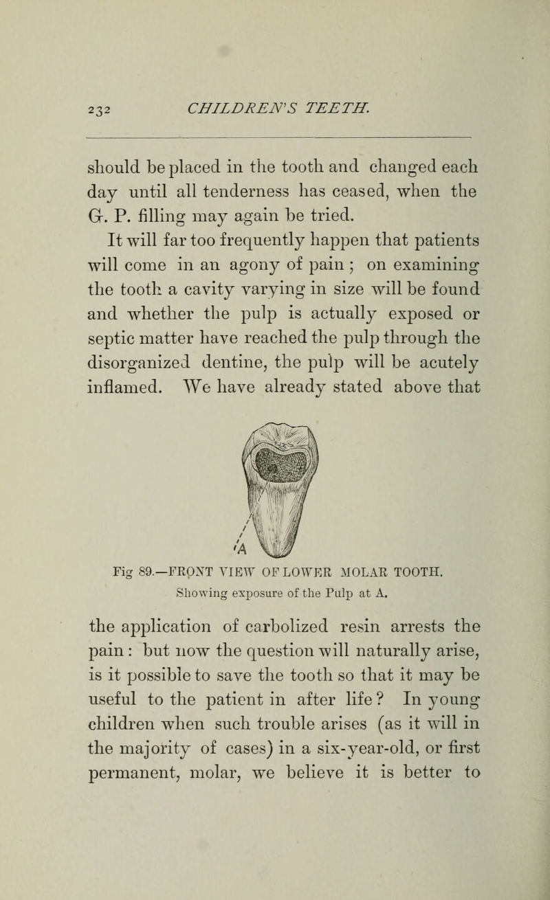 should be placed in the tooth and changed each day until all tenderness has ceased, when the Gr. P. filling may again be tried. It will far too frequently haj^pen that patients will come in an agony of pain ; on examining the tooth a cavity varying in size will be found and whether the pulp is actually exposed or septic matter have reached the pulp through the disorganized dentine, the pulp will be acutely inflamed. We have already stated above that 'A Fig 89.—FRPXT YIEVT OF LOWER MOLAR TOOTH. Showing exposure of the Pulp at A. the application of carbolized resin arrests the pain : but now the question will naturally arise, is it possible to save the tooth so that it may be useful to the patient in after life ? In young children when such trouble arises (as it will in the majority of cases) in a six-year-old, or first permanent, molar, we believe it is better to