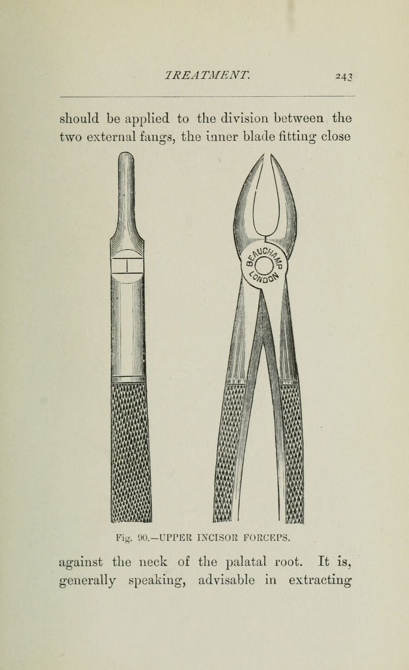 should be applied to the division between the two external fangs, the inner blade fitting close i 111 i ■ m ml m m B mi ml mA Fig. 90.-UPrER INCISOR FORCRPS. against the neck of the palatal root. It is, generally speaking, advisable in extracting