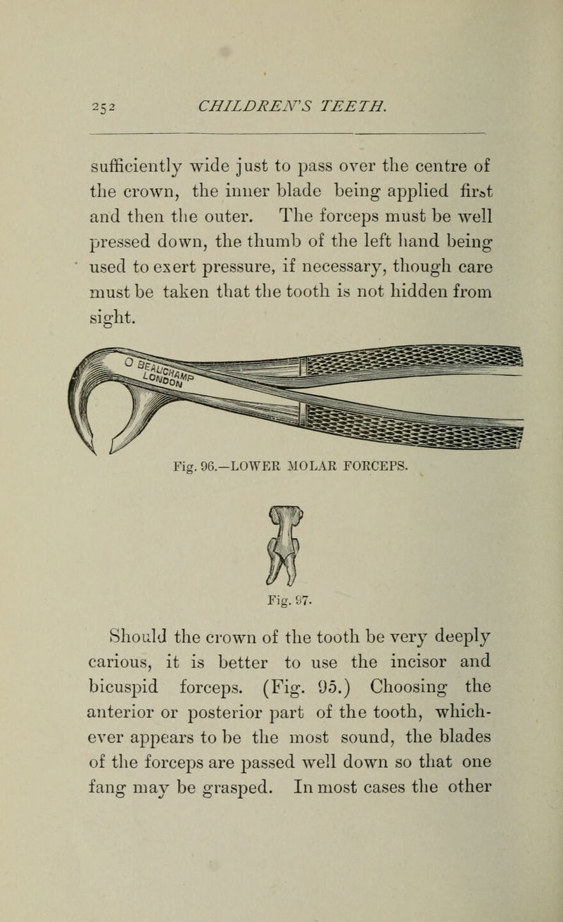 sufficiently wide just to pass over the centre of the crown, the inner blade being applied firat and then the outer. The forceps must be well pressed down, the thumb of the left hand being used to exert pressure, if necessary, though care must be taken that the tooth is not hidden from sight. Fis. 96.-L0WER MOLAR FOECEPS. Fig. 97. Should the crown of the tooth be very deeply carious, it is better to use the incisor and bicusj^id forceps. (Fig. 95.) Choosing the anterior or posterior part of the tooth, which- ever appears to be the most sound, the blades of the forceps are passed well down so that one fang may be grasped. In most cases the other