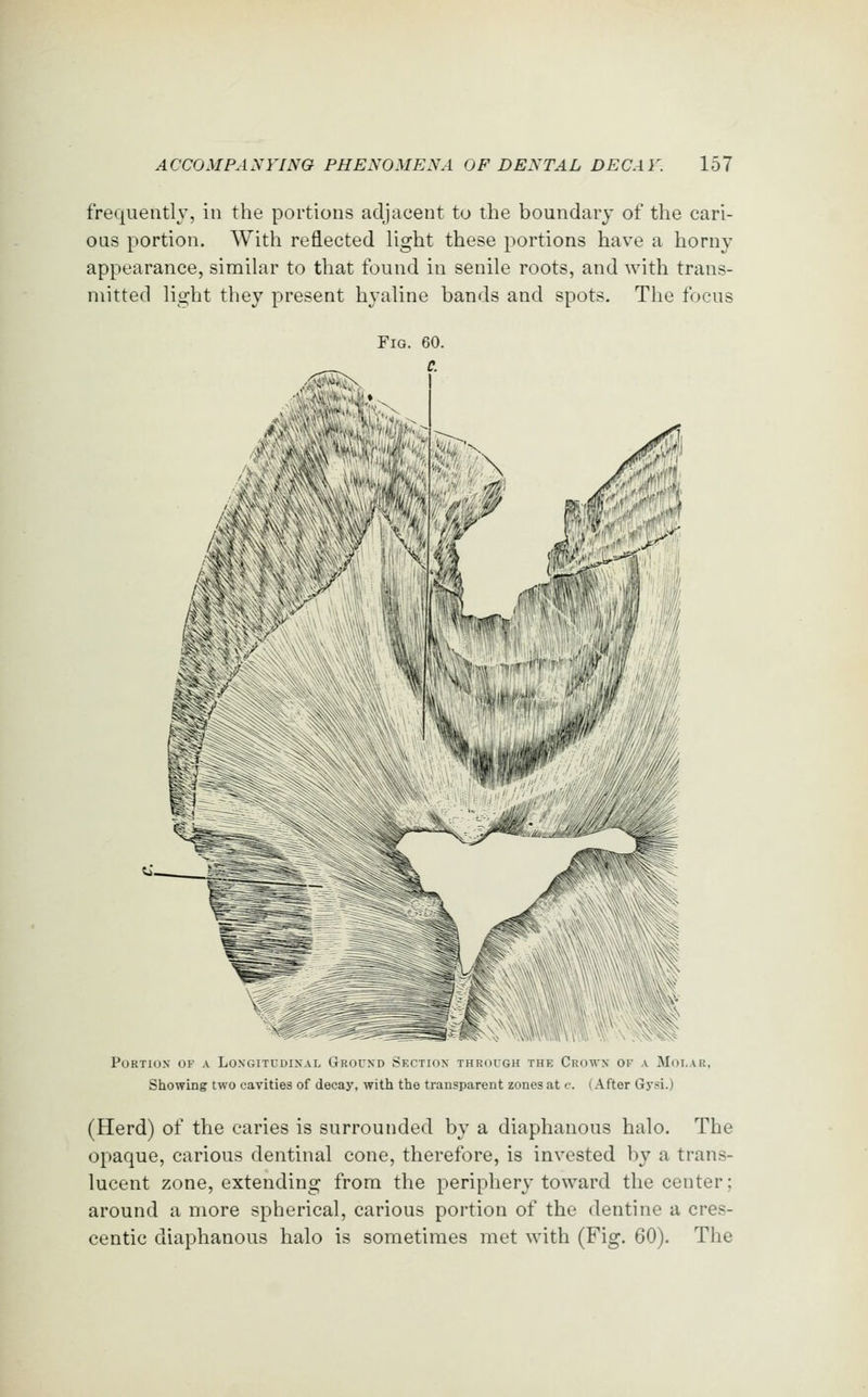 frequently, in the portions adjacent to the boundary of the cari- ous portion. With reflected light these portions have a horny appearance, similar to that found in senile roots, and with trans- mitted light they present hyaline bands and spots. The focus Fig. 60. c. Portion of a Loxgitudixal Grocsd Skction through the Crow.v ok a Mdi.ar, Showing two cavities of decay, with the transparent zones at c. (After Gj-si.) (Herd) of the caries is surrounded by a diaphanous halo. The opaque, carious dentinal cone, therefore, is invested by a trans- lucent zone, extending from the periphery toward the center; around a more spherical, carious portion of the dentine a cres- centic diaphanous halo is sometimes met with (Fig. 60). The