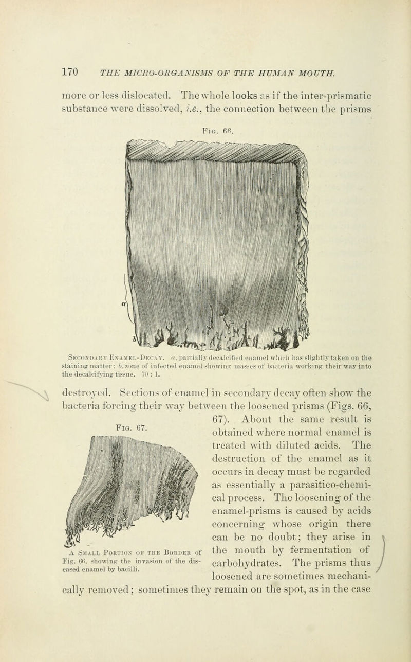 more or less dislocated. The whole looks f,s if the inter-prismatic substance were dissolved, i.e., the connection between the prisms F\n. fiP. Fig. 67. Secondary Examkl-Decay. <». partially deealritiud ouauifl whuh has slightly taken on the staining matter; /j.zone of infected enamel showin,; mas.-es of bacteiia working their way into the decalcifying tissue. 70 : 1. destroyed. Sections of enamel in seeoiidarv decay often show the bacteria forcing their way between the loosened prisms (Figs. ^^., 67). About the same result is obtained where normal enamel is treated wdth diluted acids. The destruction of the enamel as it occurs in decay must be regarded as essentially a parasitico-chemi- cal process. The loosening of the enamel-prisms is caused by acids concerning whose origin there can be no doubt; they arise in the mouth by fermentation of carbohydrates. The prisms thus loosened are sometimes mechani- cally removed; sometimes they remain on the spot, as in the case ^ nm A Small Portion ok the Border of Fig. 6fi, showing the invasion of the dis- eased enamel by bacilli.