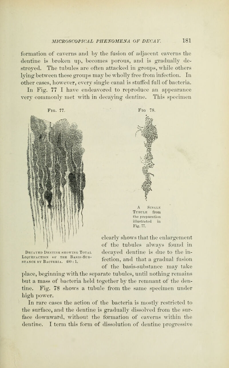 formation of caverns and by the fusion of adjacent caverns the dentine is broken up, becomes porous, and is gradually de- stroyed. The tubules are often attacked in groups, while others lying between these groups may be wholly free from infection. In other cases, however, every single canal is stuifed full of bacteria. In Fig. 77 I have endeavored to reproduce an appearance very commonly met with in decaying dentine. This specimen Fig. 77. Fig 78. ■ W •St.! A SiNCiLE Tubule from the preiiaration illustrated in Fig. 77. clearly shows that the enlargement of the tubules always found in decayed dentine is due to the in- fection, and that a gradual ftision of the basis-substance may take place, beginning with the separate tubules, until nothing remains but a mass of bacteria held together by the remnant of the den- tine. Fig. 78 shows a tubule fi'om the same specimen under high power. In rare cases the action of the bacteria is mostly restricted to the surface, and the dentine is gradually dissolved from the sur- face downward, without the formation of caverns within the dentine. I term this form of dissolution of dentine progressive Decayed Dentine showing Total Liquefaction oe the Basis-Sub- stance BY Bacteria. 400 : 1.