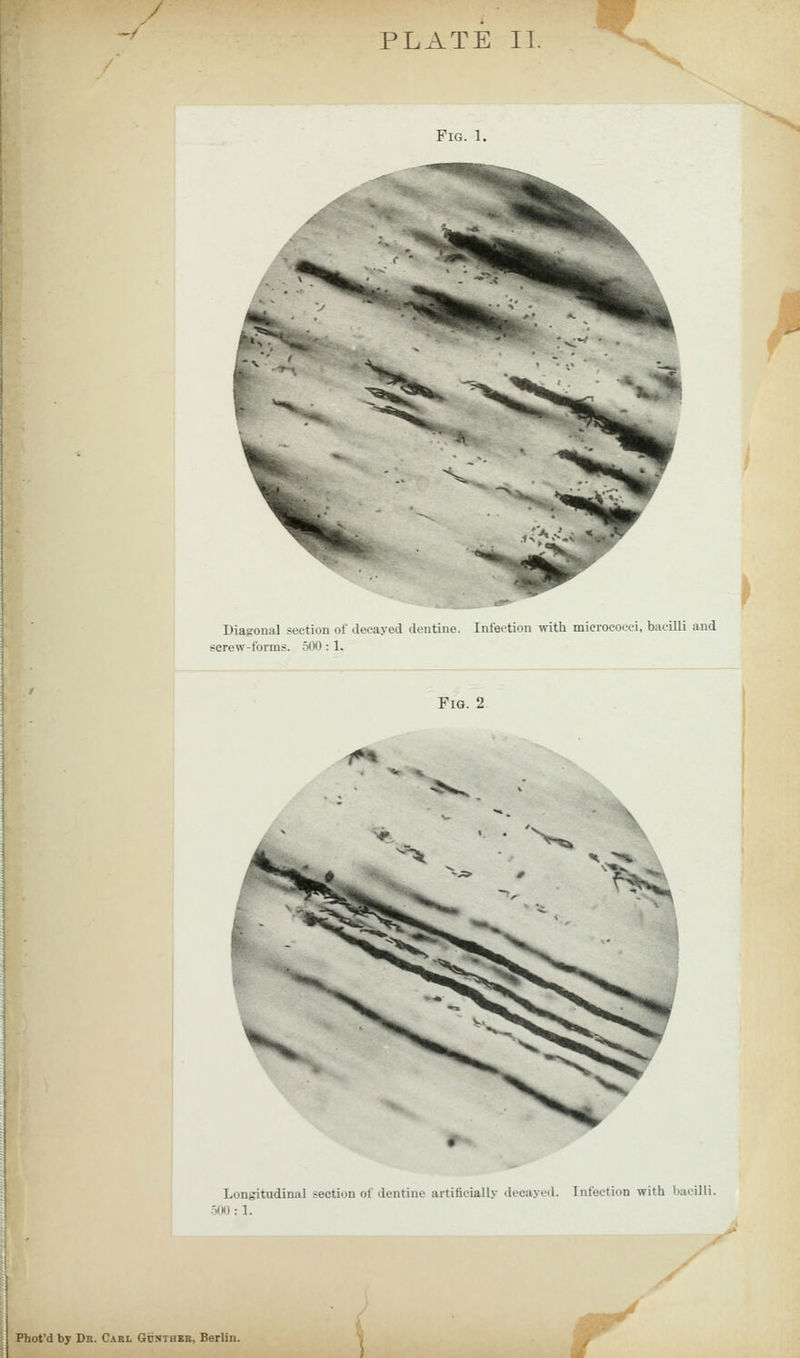 / PLATE II. Fig. 1. ^ Diagonal section of decayed dentiriL-. Intertion with micrococci, bacilli and screw-forms. 500: 1, Fig. 2 Longitudinal section of dentine artificially ilecayed. Infection with liaeilli. •iiM): 1. Phot'd by Dr. C.\rl GiJSTHBR, Berlin. 1^