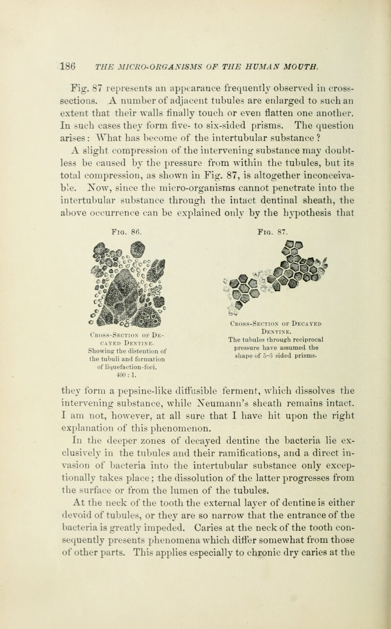 Fig. 87 represents an appcarauee frequently observed in cross- sections. A number of adjacent tubules are enlarged to such an extent that their walls finally touch or even flatten one another. In such cases they form live- to six-sided prisms. The question arises: AVhat has become of the intertubular substance ? A slight compression of the intervening substance may doubt- less be caused by the pressure from within the tubules, but its total compression, as shown in Fig. 87, is altogether inconceiva- ble. Xow, since the micro-organisms cannot penetrate into the intertubular substance through the intact dentinal sheath, the above occurrence can be explained only by the liA'pothesis that Fig. 86. Fig. 87. Cross-Section of Decayed Dentine. The tubules through reciprocal pressure have assumed the shape of 5-3 sided prisms. Cross-Section of De- cayed Dentine. Showing the distention of the tubuli and formation of liquefaetion-foei. 400 : 1. they form a pepsine-like diti'asible ferment, which dissolves the intervening substance, while Xeumann's sheath remains intact. I am not, however, at all sure that I have hit upon the right explanation of this phenomenon. In the deeper zones of decayed dentine the bacteria lie ex- clusively in the tubules and their ramifications, and a direct in- vasion of bacteria into the intertubular substance only excep- tionally takes place; the dissolution of the latter progresses from the surface or from the lumen of the tubules. At the neck of the tooth the external layer of dentine is either devoid of tubules, or they are so narrow that the entrance of the bacteria is greatly impeded. Caries at the neck of the tooth con- sequently presents phenomena which differ somewhat from those of other parts. This applies especially to chronic dry caries at the
