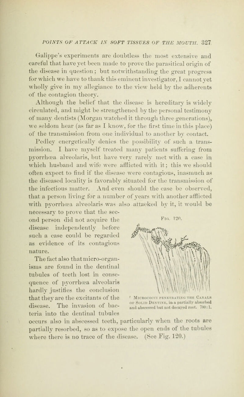 Galippe's experiments are doubtless the most extensive and careful that have vet been made to prove the parasitical origin of the disease in question; but notwithstanding the great progress for which we have to thank this eminent investigator, I cannot vet Avholly give in my allegiance to the view held by the adherents of the contagion theory. Although the belief that the disease is hereditary is widely circulated, and might be strengthened by the personal testimony of many dentists (Morgan watched it through three generations), we seldom hear (as far as I know, for the first time in this place) of the transmission from one individual to another by contact. Pedley energetically denies the possibility of such a trans- mission. I have myself treated many patients suffering from pyorrhcea alveolaris, but have very rarely met with a case in which husband and wife were alliicted witii it; this we sliould often expect to find if the disease were contagious, inasmuch as the diseased locality is favorably situated for the transmission of the infectious matter. And even sliould the case be observed, that a person li\dng for a nuinber of years with another afiiicted with pyorrhoea alveolaris was also attacked by it, it would be necessary to prove that the sec- ond person did not acquire the ^f- ^-^■ disease independentlv before /iste^^,. ^-*=%e.. such a case could be regarded ,&■«' vn i W^v '^ - ••' as evidence of its contagious \\ K'f^}^^^^^-^^^.^ nature. The fact also that micro-organ- isms are found in the dentinal 4V!lV'> tubules of teeth lost in conse- \w ii*it,wv v. quence of pyorrha'a alveolaris v\ • ' ' i'\\\\Vr' hardly justifies the conclusion \ V^'^iWWVifplpW''' that thev are the excitants of the ' Micrococci pesktrating thk Canals ,.  rr\\ • • i? 1 OF Solid Dextixk, in a partially absorbed disease. ine invasion Ot bac- and abscessed but not decayed root. 700:1. teria into the dentinal tubules occurs also in abscessed teeth, particularly when the roots are partially resorbed, so as to expose the open ends of the tubules where there is no trace of the disease. (See Fig. 120.)