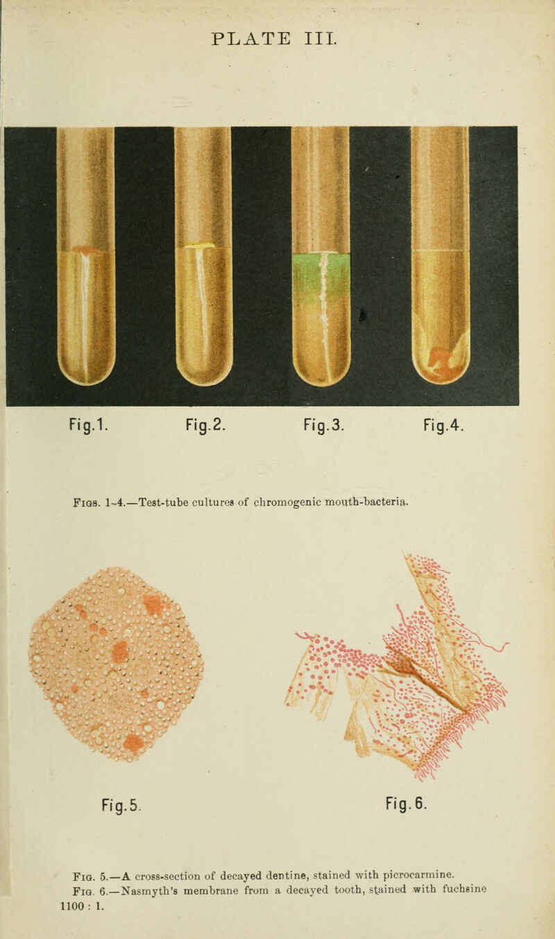 PLATE III. Fig.1. Fig.2. Fig.3. Fig.4. Figs. 1-4.—Test-tube cultures of cbromogenic mouth-bacteria. Fig.5. Fig. 6. Fig. 5.—A cross-section of decayed dentine, stained with picrocannine. FiQ. 6.—Nasmyth's membrane from a decayed tooth, stained with fuchsine 1100: 1.