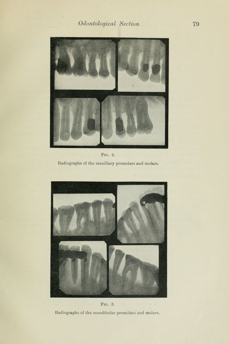 Fig. 2. Kadiographs of the maxillary premolars and molars. Fig. 3. Radiographs of the maadibular premolars and molars.