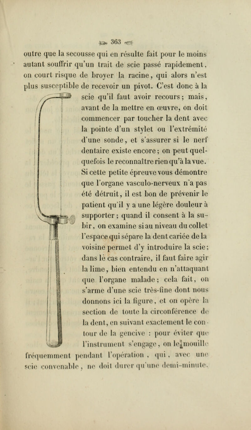 outre que la secousse qui en resulte fait pour le moins autant souffrir qu'un trait de scie passe rapidement, on court risque de broyer la racine, qui alors n'est plus susceptible de recevoir un pivot. C'est done a la scie qu'il faut avoir recours; mais, avant de la mettre en oeuvre, on doil commencer par toucher la dent avec la pointe d'un stylet ou Textremite d'une sonde, et s'assurer si le nerf dentaire existe encore; on pent quel- quefois le reconnaitre rien qu'a la vue. Si cette petite epreuve vous demontrc que I'organe vasculo-nerveux n'a pas ete detruit, il est bon de prevenir le patient qu'il y a une legere douleur a supporter; quand il consent a la su- bir, on examine siau niveau du collet Tespace qui separe la dent cariee de la voisine permet d'y introduire la scie; dans le cas contraire, il faut faire agir la lime, bien entendu en n'attaquant ([ue I'organe malade; cela fait, on s'arme d'une scie tres-fine dont nous donnons ici la figure, et on opore la section de toute la circonference d(^ la dent, en suivant cxactc^ment le con tour de la gencive : pour rviler qu<' rinstrunnMit s'engago, on loj^mouillc frequemment pendanl ro|)eration , qui, hmm une scie convenablr , \w doil dmcr (HIudc dcini-inimih^