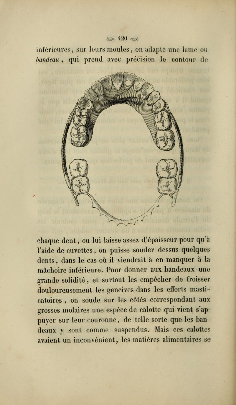 iiiferieuros, sur leiirs monies, on adaple iino hime ou bandeau, qui prcnd avec precision le contour do chaque dent, ou lui laisse assez d'epaisseur pour qu'a I'aide de cuvettes, on puisse souder dessus quelques dents, dans le cas ou il viendrait a en manquer a la machoire inferieure. Pour donner aux bandeaux une grande solidite, et surtout les emp^cher de froisser douloureusement les gencives dans les efforts masti- catoires , on soude sur les c6tes correspondant aux grosses molaires une espece de calotte qui vient s'ap- puyer sur leur couronne, de telle sorte que les ban- deaux y sont comme suspendus. Mais ces calottes avaient un inconvenient, les matieres alimentaires se