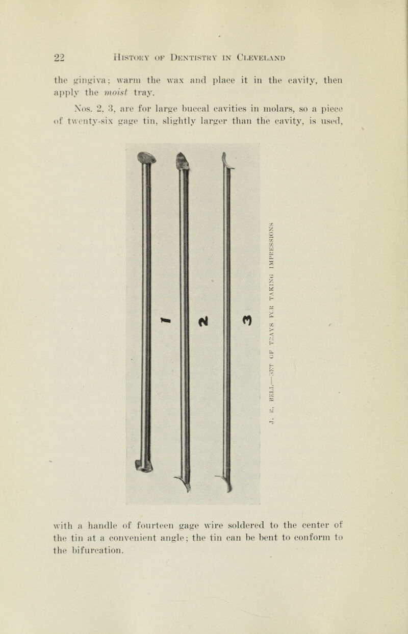 the uiiiiiiva: warm the wax and place it in the cavity, then apply the iiioist tray. Xos. 2, 8, are for lari>e buccal cavities in molars, so a piece of twenty-six <i-ao(> tin, slig'htly lart>'er than the cavity, is used, <1 with a handle of fourteen gage wire soldered to the center of the tin at a convenient angle; the tin can be bent to conform to the bifurcation.