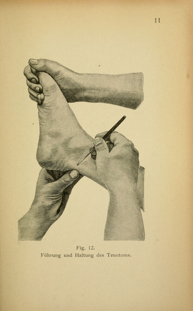 Fig. 12. Führung und Haltung des Tenotoms.