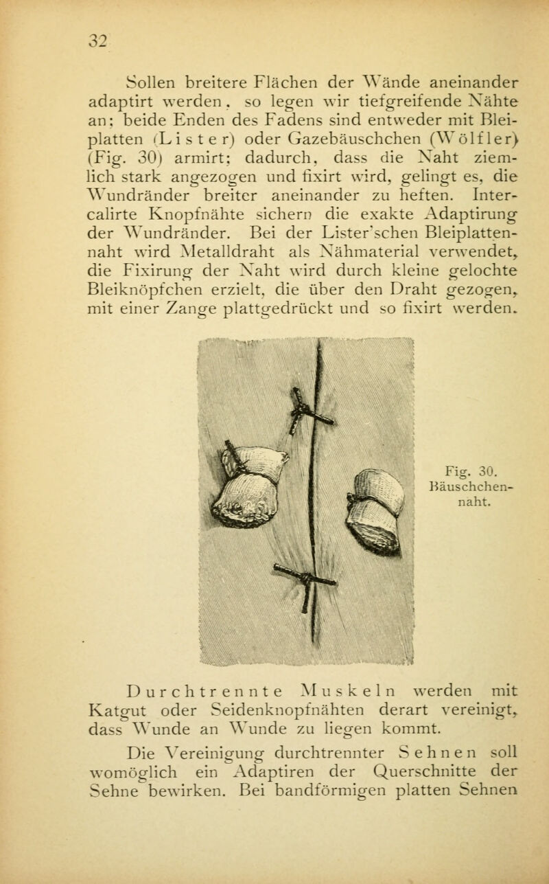 Sollen breitere Flächen der Wände aneinander adaptirt werden . so legen wir tiefgreifende Xähte an: beide Enden des Fadens sind entweder mit Blei- platten «Liste r) oder Gazebäuschchen (Wolfler) (Fig. 30) armirt: dadurch, dass die Xaht ziem- lich stark angezogen und rlxirt wird, gelingt es. die Wundränder breiter aneinander zu heften. Inter- calirte Knopfnähte sichern die exakte Adaptirung der Wundränder. Bei der Lister'schen Bleiplatten- naht wird Metalldraht als Nähmaterial verwendet,, die Fixirung der Xaht wird durch kleine gelochte Bleiknöpfchen erzielt, die über den Draht gezogen» mit einer Zange plattgedrückt und so rlxirt werden. Fig. 30. Bäuschchen- naht. Durch trennte Muskeln werden mit Katgut oder Seidenknopfnähten derart vereinigt, dass Wunde an Wunde zu liegen kommt. Die Vereinigung durchtrennter Sehnen soll womöglich ein Adaptiren der Querschnitte der Sehne bewirken. Bei bandförmigen platten Sehnen