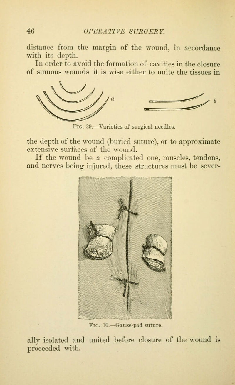 distance from the margin of the wound, in accordance with its depth. In order to avoid the formation of cavities in the closure of sinuous wounds it is wise either to unite the tissues in Fig. 29.—Varieties of surgical needles, the depth of the wound (buried suture), or to approximate extensive surfaces of the wound. If the wound be a complicated one, muscles, tendons, and nerves being injured, these structures must be sever- Fig. 30.—Gauze-pad suture. ally isolated and united before closure of the wound is proceeded with.