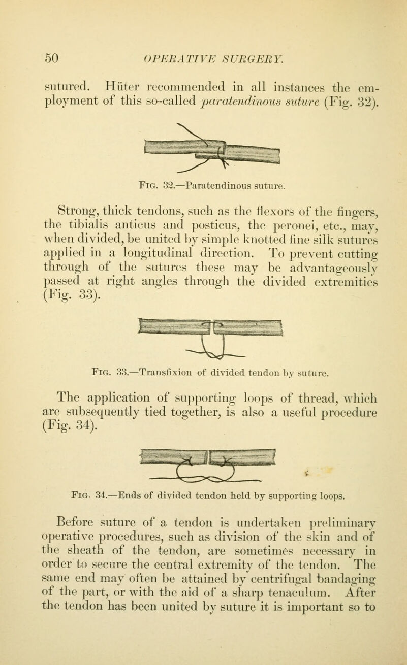 sutured. Hiiter recommended in all instances the em- ployment of this so-called paratendinous suture (Fig. 32). Fig. 32.—Paratendinous suture. Strong, thick tendons, such as the flexors of the fingers, the tibialis anticus and posticus, the peronei, etc., may, when divided, be united by simple knotted fine silk sutures applied in a longitudinal direction. To prevent cutting through of the sutures these may be advantageously passed at right angles through the divided extremities (Fig. 33). Fig. 33.—Transfixion of divided tendon by suture. The application of supporting loops of thread, which are subsequently tied together, is also a useful procedure (Fig. 34). Fig. 34.—Ends of divided tendon held by supporting loops. Before suture of a tendon is undertaken preliminary operative procedures, such as division of the skin and of the sheath of the tendon, are sometimes necessary in order to secure the central extremity of tlie tendon. The same end may often be attained by centrifugal bandaging of the part, or with the aid of a sharp tenaculum. After the tendon has been united by suture it is important so to