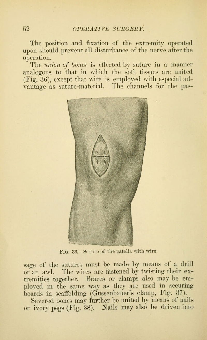 The position and fixation of the extremity operated upon should prevent all disturbance of the nerve after the operation. The union of hones is effected by suture in a manner analogous to that in which the soft tissues are united (Fig. 36), except that wire is employed with especial ad- vantage as suture-material. The channels for the pas- FiG. 36.—Suture of the patella with wire. sage of the sutures must be made by means of a drill or an awl. The Avires are fastened by twisting their ex- tremities together. Braces or clamps also may be em- ployed in the same way as they are used in securing boards in scaffolding (Gussenbauer's clamp, Fig. 37). Severed bones may further be united by means of nails or ivory pegs (Fig. 38). Nails may also be driven into