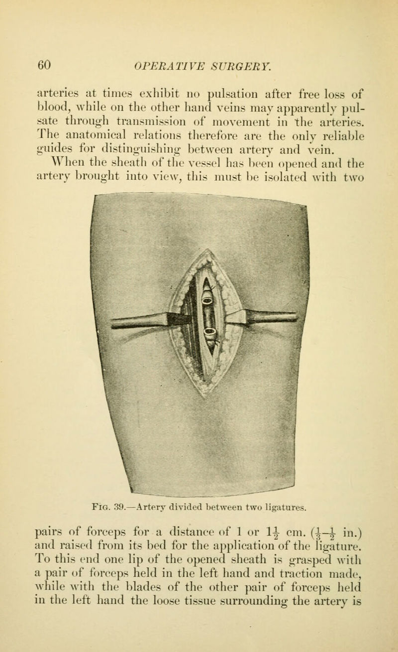 arteries at times exhibit no pulsation after free loss of blood, while on the other hand veins may apparently pul- sate through transmission of movement in the arteries. The anatomical relations therefore are the only reliable guides for distinguisliing between artery and vein. When the sheath of the vessel has been opened and the artery brought into view, this must be isolated with two Fig. 39.—Artery divided between two ligatures. pairs of forceps for a distance of 1 or l-l- cm. (l-i in.) and raised from its bed for the application of the ligature. To this end one lip of the opened sheath is grasped with a pair of forceps held in the left hand and traction made, while with the blades of the other pair of forceps held in the left hand the loose tissue surrounding the artery is