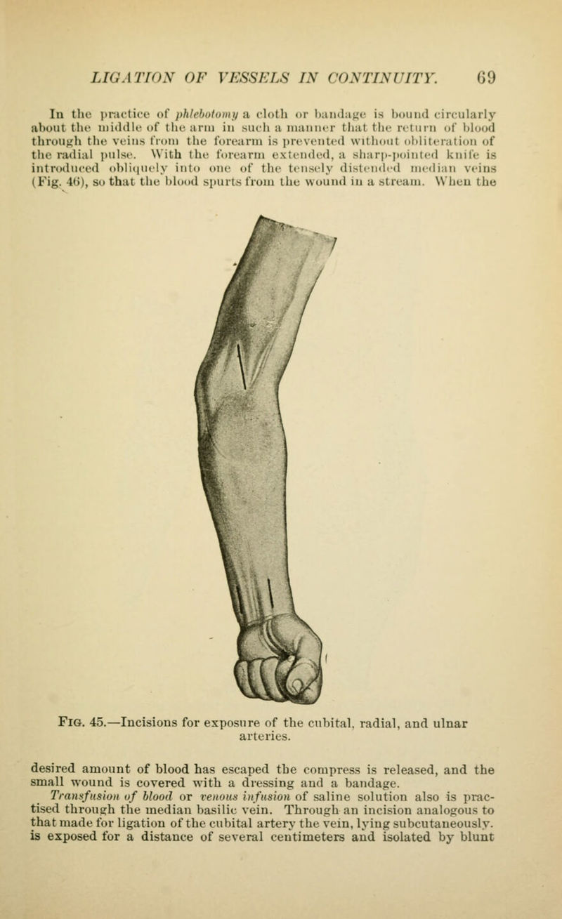 In the ]tr.icti<'e of phlehoio about thr niiddlt' of tl ]thlehi)t()}ity a cloth or handaK*' is hound circularly ahout tlic niKKlU' oi llu-arm in such a niauiicr that the return of hlood throujih the veins from the forearm is prevented witiiout ohliteration of the radial pulse. With the forearm extended, a sharp-pointed knife is introdiu-ed obli(|Uely into one of the tensely distcndrtl median veins (Fig. 4t»), so thai the hlood spurts from the wound in a stream. When the Fig. 45.—Incisions for exposure of the cubital, radial, and ulnar arteries. desired amount of blood has escaped the compress is released, and the small wound is covered with a dressing and a bandage. Transfusion uf blood or venous infusion of saline solution also is prac- tised through the median basilic vein. Through an incision analogous to that made for ligation of the cubital artery the vein, lying subcutaneously. is exposed for a distance of several centimeters and isolated by blunt