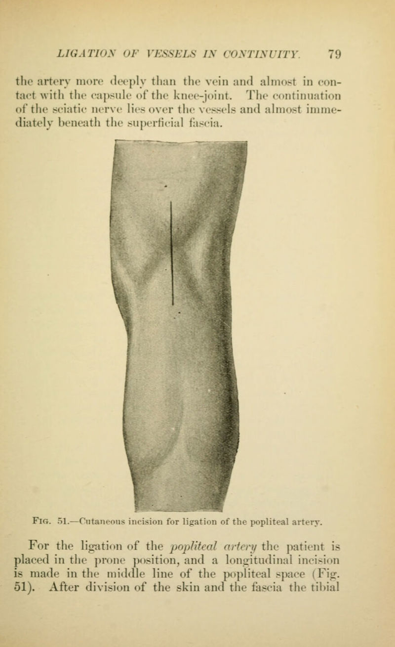 tlio artery more docply tlian the vein and almost in con- tact with tlu' ca])sulc of the knee-joint. The continuation of the sciatic nerve lies over the vessels and almost imme- diately beneath the superticial fascia. Fig. 51.—Cutaneous incision for ligation of the popliteal artery. For the ligation of the popliteal artery the patient is placed in the prone position, and a longitudinal incision is made in the middle line of the popliteal sj)ace (Fi«r. 51). After division of the skin and the fascia the tihial