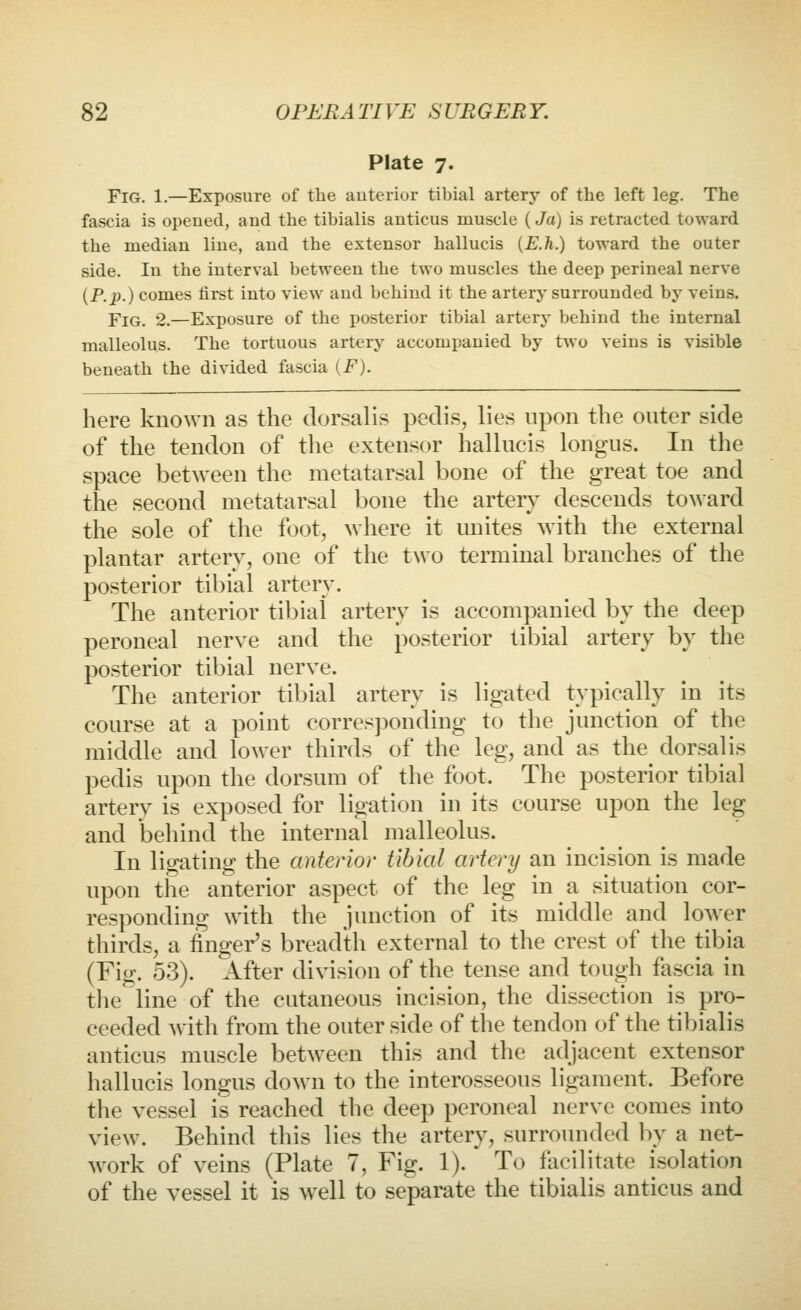 Plate 7. Fig. 1.—Exposure of the auterior tibial artery of the left leg. The fascia is opened, and the tibialis antieus muscle {Ja) is retracted toward the median Hue, and the extensor hallucis {E.li.) toward the outer side. In the interval between the two muscles the deep perineal nerve (P.jp.) comes first into view and behind it the artery surrounded by veins. Fig. 2.—Exposure of the posterior tibial artery behind the internal malleolus. The tortuous artery accompanied by two veins is visible beneath the divided fascia {F). here known as the dorsalis pedis, lies upon the outer side of the tendon of the extensor hallucis longus. In the space between the metatarsal bone of the great toe and the second metatarsal bone the artery descends toward the sole of the foot, where it miites with the external plantar artery, one of the two terminal branches of the posterior tibial artery. The anterior tibial artery is accompanied by the deep peroneal nerve and the posterior tibial artery by the posterior tibial nerve. The anterior tibial artery is ligated typically in its course at a point corres])onding to the junction of the middle and lower thirds of the leg, and as the^ dorsalis pedis upon the dorsum of the foot. The posterior tibial artery is exposed for ligation in its course upon the leg and behind the internal malleolus. In ligating the anterior tibial artery an incision is made upon the anterior aspect of the leg in a situation cor- responding with the junction of its middle and lower thirds, a finger's breadth external to the crest of the tibia (Fig. 53). After division of the tense and tough fascia in the line of the cutaneous incision, the dissection is pro- ceeded with from the outer side of the tendon of the tibialis antieus muscle between this and the adjacent extensor hallucis longus down to the interosseous ligament. Before the vessel is reached the deep peroneal nerve comes into view. Behind this lies the artery, surrounded by a net- w^ork of veins (Plate 7, Fig. 1). To facilitate isolation of the vessel it is well to separate the tibialis antieus and