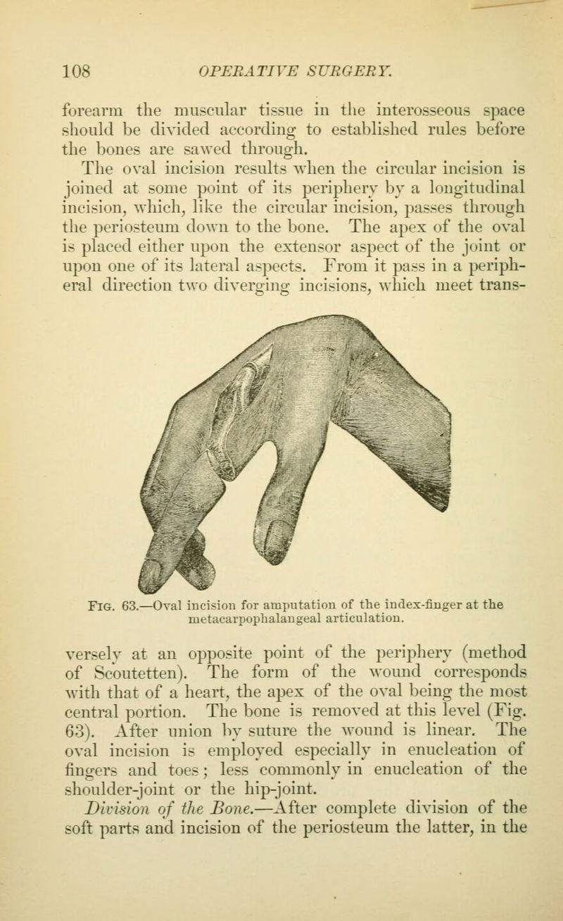 forearm the muscular tissue in the interosseous space should be divided according to established rules before the bones are sawed through. The oval incision results when the circular incision is joined at some point of its periphery by a longitudinal incision, which, like the circular incision, passes through the periosteum down to the bone. The apex of the oval is placed either upon the extensor asj^ect of the joint or upon one of its lateral aspects. From it pass in a periph- eral direction two diverging incisions, which meet trans- FlG. 63.—Oval incision for amputation of the index-finger at the metacarpophalangeal articulation. verselv at an opposite point of the periphery (method of Scoutetten). The form of the wound corresponds with that of a heart, the apex of the oval being the most central portion. The bone is removed at this level (Fig. 63). After union by suture the wound is linear. The oval incision is employed especially in enucleation of fingers and toes; less commonly in enucleation of the shoulder-joint or the hip-joint. Division of the Bone.—After complete division of the soft parts and incision of the periosteum the latter, in the