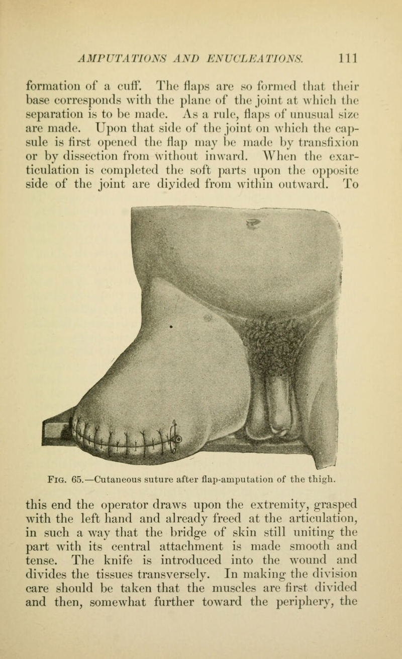 formation of a cuff. T\w Haps are so formed that their base c'orres]K)n(ls with tlie phme of tlie joint at which the separation is to be made. As a rub', Haps of unusual siz(.' are made. Upon that side of tlie joint on wliich the cap- sule is first opened the flap may l)e made by transfixion or by dissection from without inward. AVhen the exar- tieulation is completed the soft j)arts upon the opposite side of the joint are diyided from within outward. To ^' Fig. 65.—Cutaneous suture after flap-amputation of the thigh, this end the operator draws upon the extremity, grasped with the left hand and already freed at the articulation, in such a way that the bridge of skin still uniting the part wnth its central attachment is made smootli and tense. The knife is introduced into the wound and divides the tissues transversely. In making the division care should be taken that the muscles are first divided and then, somewhat further toward the periphery, the