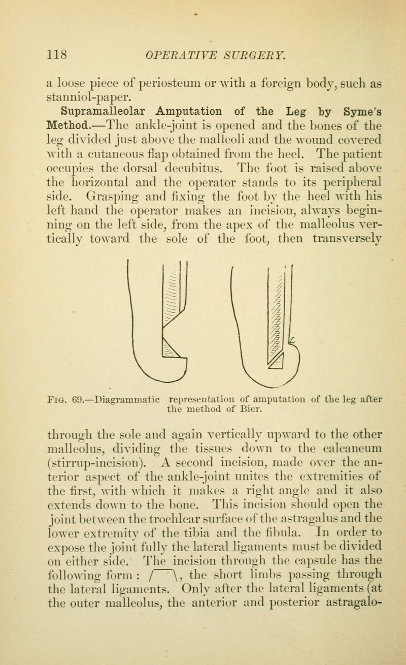 a loose piece of periosteum or Avith a foreign body, such as stanniol-paper. Supramalleolar Amputation of the Leg by Syme's Method.—The ankle-joint is opened and the bones of the leg divided just above the malleoli and the wound covered Avith a cutaneous flap obtained from the heel. The patient occupies the dorsal decubitus. The foot is raised above the horizontal and the operator stands to its peripheral side. Grasping and fixing the foot by the heel Avith his left hand the operator makes an incision, ahvays begin- ning on the left side, from the apex of the malleolus ver- tically toAvard the sole of the foot, then transversely Fig. 69.—Diagrammatic representation of amputation of the leg after the method of Bier. through the sole and again vertically upward to the other malleolus, dividing the tissues down to the caicaneum (stirrup-incision). A second incision, nuide over the an- terior aspect of the ankle-joint unites the extremities of the first, Avith which it makes a riglit angle and it also extends down to the bone. This incision should open the joint betAveen the trochlear surface of the astragalus and the lower extremity of tlie ti])ia and the fi])ula. In order to expose the joint fully the lateral ligaments must be divided on either side. The incision through the capsule has the folloAving form : / ~\, the short limbs passing through the lateral ligaments. Only after the lateral ligaments (at the outer malleolus, the anterior and posterior astragalo-