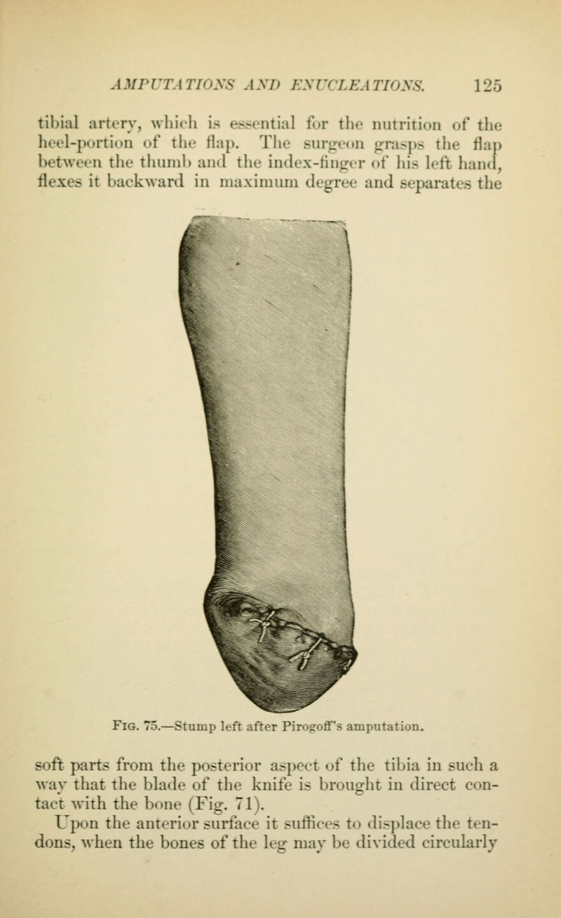 tibial artery, which is essential for the nutrition of the heel-portion of the flap. The surgeon grasps the flap between the thunil) and the index-iingcr of his left hand, flexes it backward in maximum degree and separates the Fig. 75.—Stump left after PirogoflTs amputation. soft parts from the posterior aspect of the tibia in such a way that the blade of the knife is brought in direct con- tact with the bone (Fig. 71). Upon the anterior surface it suffices to di.splace the ten- dons, when the bones of the leg may be divided circularly