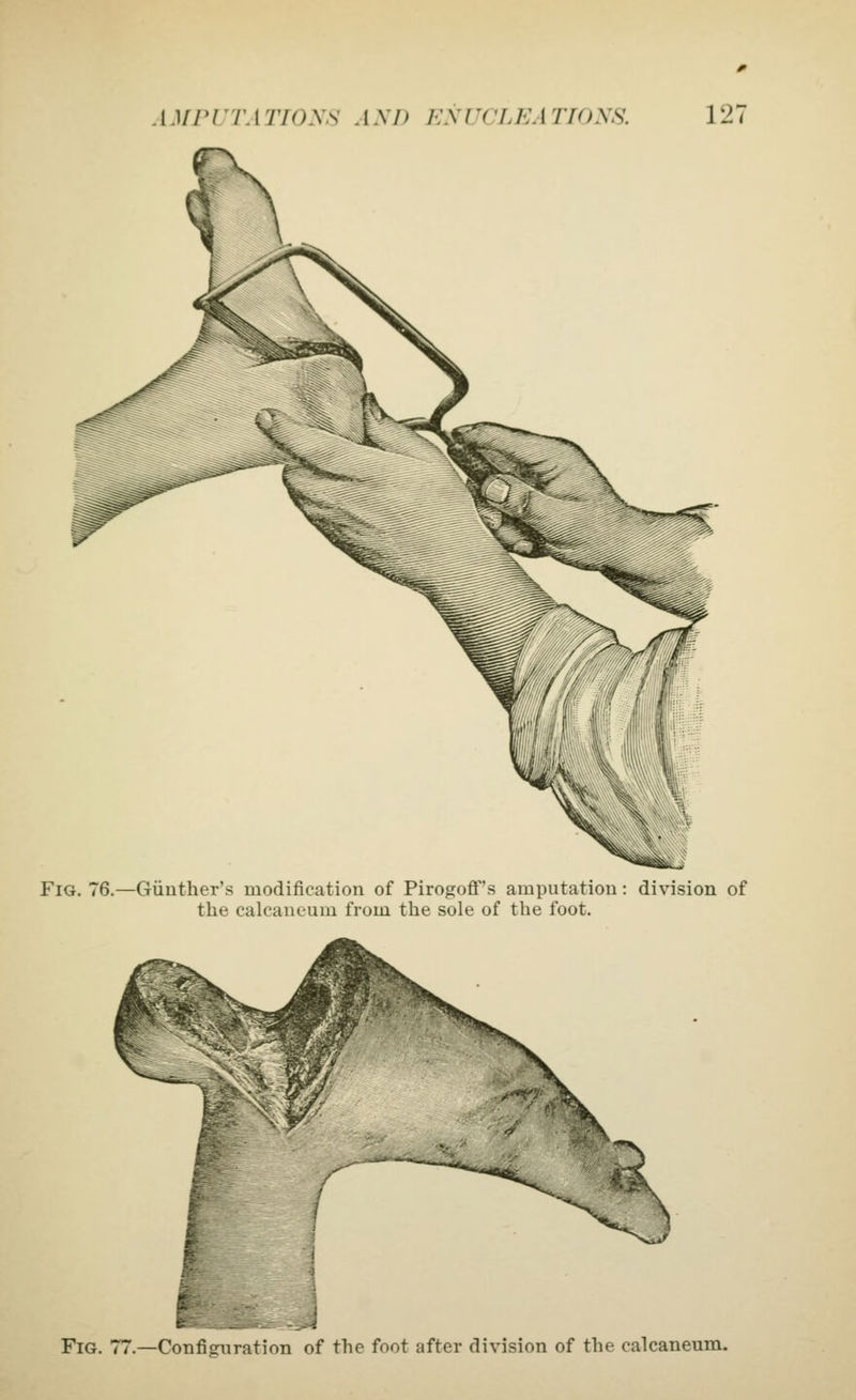 AMriTA TlOys AMJ JjyUCLEATIONS. 12' Fig. 76.—Giinther's modification of Pirogoff's amputation: division of the calcancum from the sole of the foot. Fig. 77.—Configuration of the foot after division of the calcancum.