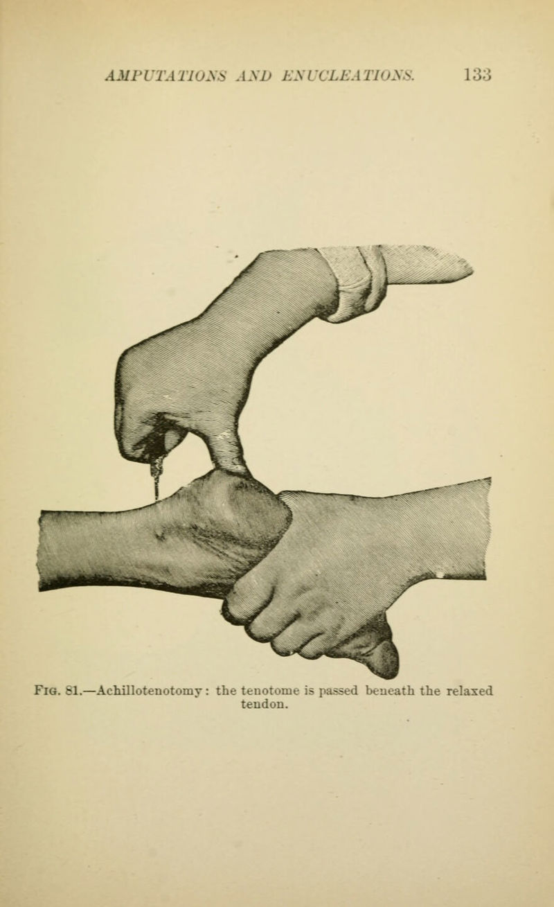 Fig. si.—Achilloteiiotomy: the tenotome is passed beneath the relaxed tendon.