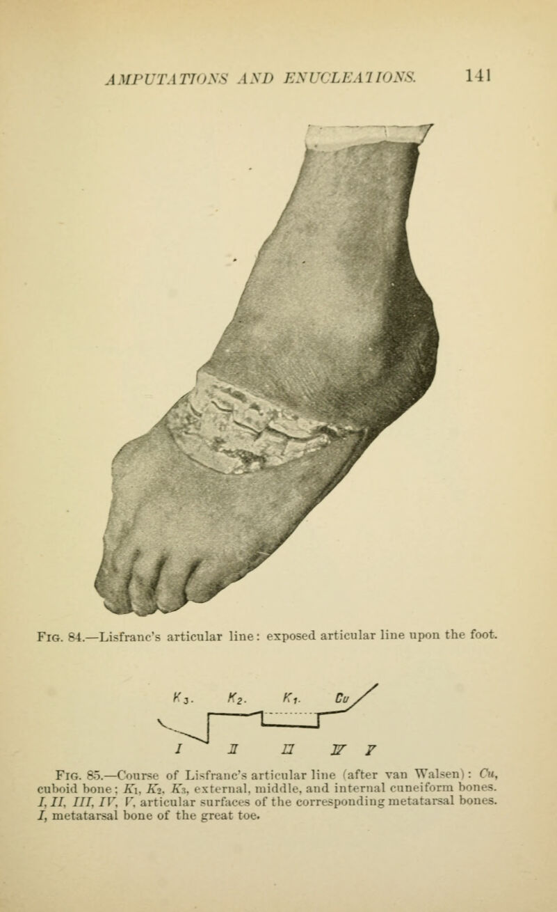 Fig. 84.—Lisfranc's articular line: exposed articular line upon the foot. Fig. 85.—Course of Lisfranc's articular line Rafter van Walsen): 0«, cuboid bone; A'l, K2. A'3, external, middle, and internal cuneiform bones. /,//, ///, IV, r, articular surfaces of the corresponding metatarsal bones. I, metatarsal bone of the great toe.