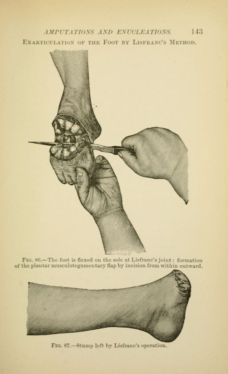 EXAKTICULATIoN OF THE FOOT BY LiSFRANC'S METHOD. Fig. 86.—The foot is flexed on the sole at Lisfranc's joint: formation of the plantar musculotegumeutary flap by incision from within outward. ^^?5»!>i'^.. P^G. 87.—Stump left by Lisfranc's operation.