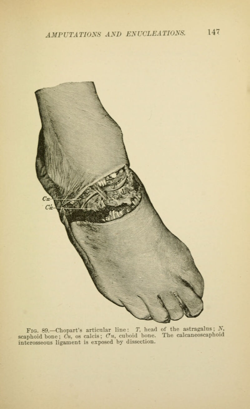 AMPUTATIOXS ASD EXUCLEATIOyS. U' Fig. 89.—Chopart's articnlar line: T. head of the astragalus: X, scaphoid bone: Cit, os calcis; Cu, cuboid bone. The calcaneoscaphoid interosseous ligament is exposed by dissection.