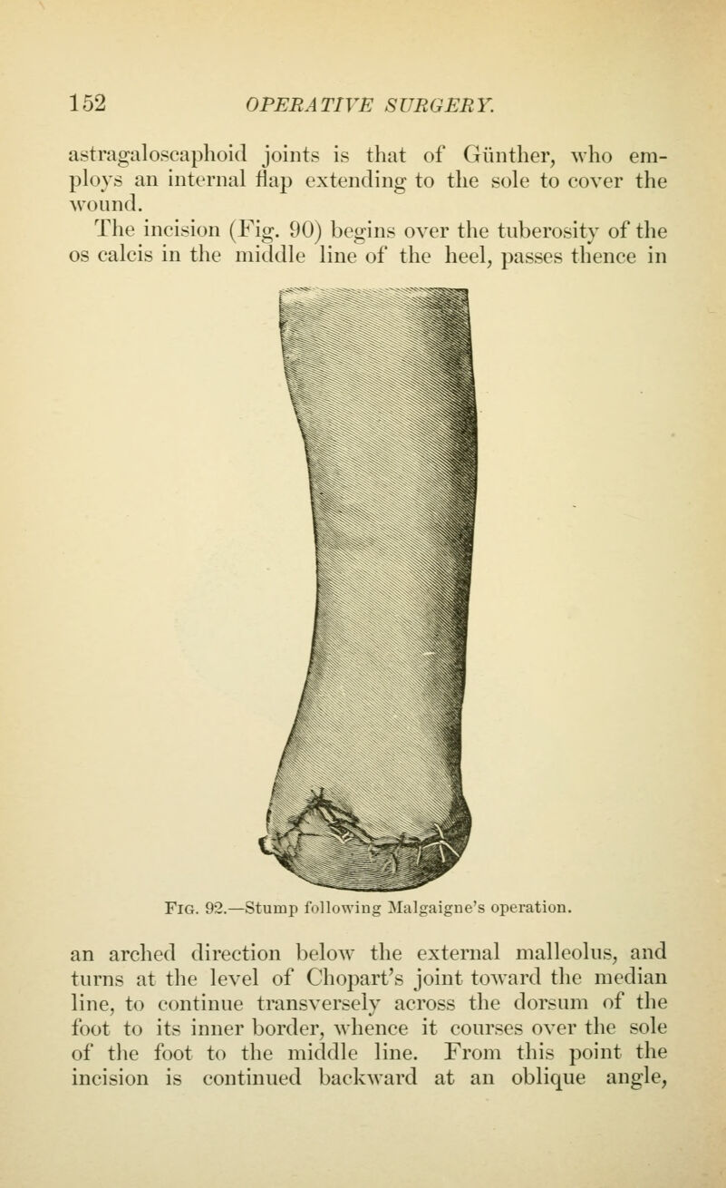 astragaloscaphoid joints is that of Giinther, who em- ploys an internal flap extending to the sole to cover the wound. The incision (Fig. 90) begins over the tuberosity of the OS calcis in the middle line of the heel, passes thence in Fig. 92.—Stumji following Malgaigne's operation. an arched direction below the external malleolus, and turns at the level of Chopart's joint toAvard the median line, to continue transversely across the dorsum of the foot to its inner border, whence it courses over the sole of the foot to the middle line. From this point the incision is continued backward at an oblique angle,