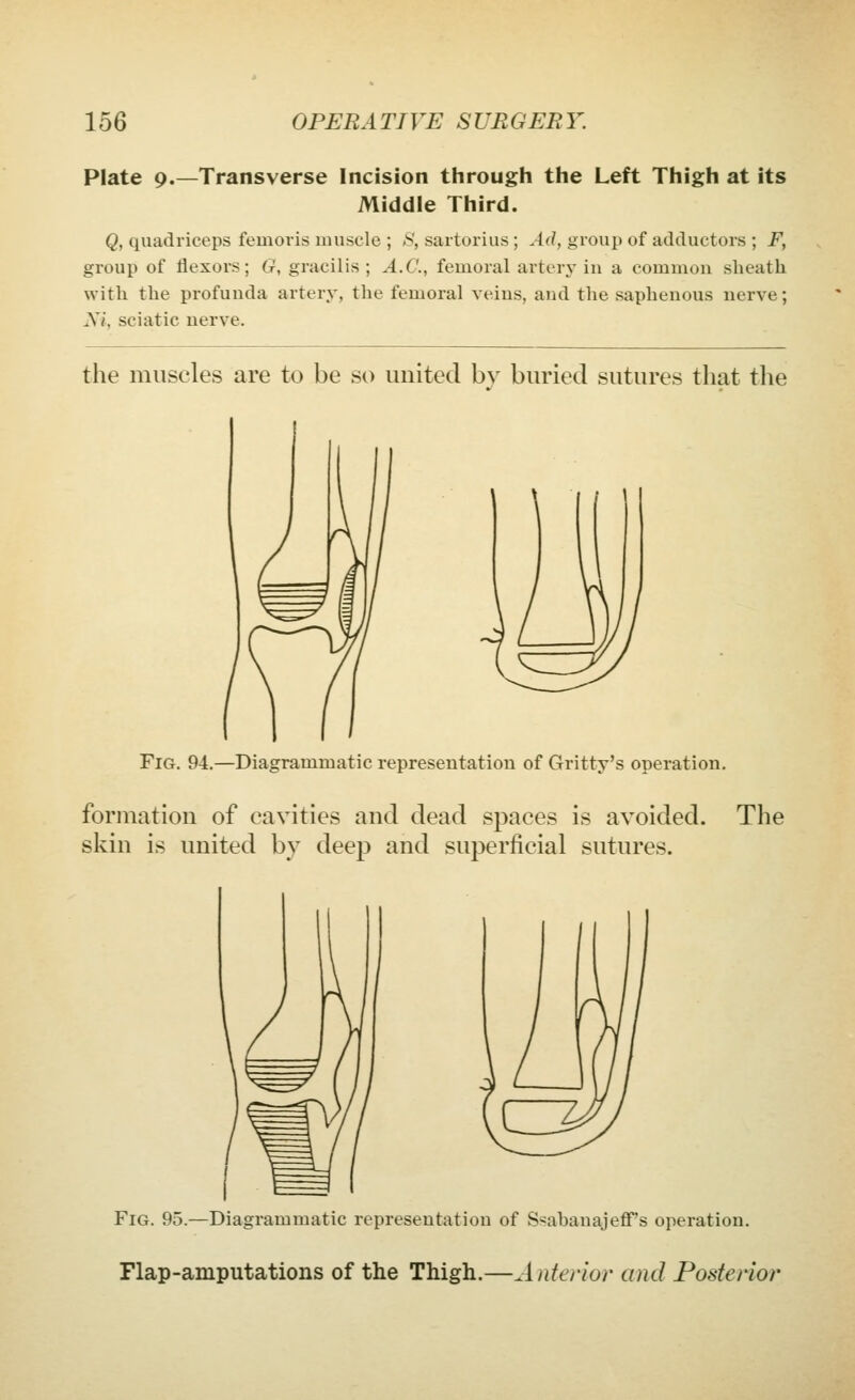 Plate 9.—Transverse Incision through the Left Thigh at its Middle Third. Q, quadriceps femoris muscle ; S, sartorius ; Ad, group of adductors ; F, group of flexors; G, gracilis; A.C., femoral arterj'in a common sheath with the profunda artery, the femoral veins, and the saphenous nerve; Xi, sciatic nerve. the muscles are to be so united bv buried sutures that the Fig. 94.—Diagrammatic representation of Gritty's operation. formation of cavities and dead spaces is avoided. The skin is united by deep and superficial sutures. Fig. 95.—Diagrammatic representation of Ssabanajeffs operation. Flap-amputations of the Thigh.—Anterior and Posterior