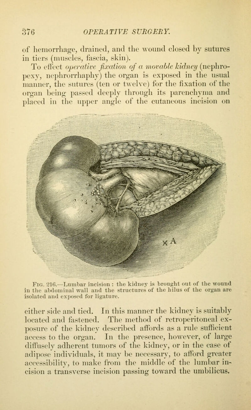 of hemorrhage, drained, and the wound closed by sutures in tiers (muscles, fascia, skin). To effect operative fixation of a movable kidney (nephro- pexy, nephrorrhaphy) the organ is exposed in the usual manner, the sutures (ten or twehe) for the fixation of the organ being passed deeply through its parenchyma and placed in the upper angle of the cutaneous incision on % ■'TV;''. I'l * m Fig. 216.—Lumbar incision : the kidney is brought out of the wound in the abdominal wall and the structures of the hilus of the organ are isolated and exposed for ligature. either side and tied. In this manner the kidney is suitably located and fastened. The method of retroperitoneal ex- posure of the kidney described affords as a rule sufficient access to the organ. In the presence, howeyer, of large diffusely adherent tumors of tlie kidney, or in the case of adipose indiyiduals, it may be necessary, to afford greater accessibility, to make from the middle of the lumbar in- cision a transyerse incision passing toward the umbilicus.