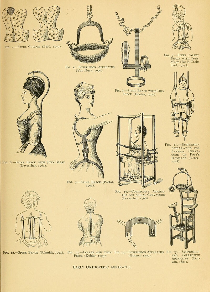 Fig. 7.—Steel Corset Brace with Jury Mast (De la Croix Skol, 1725). -Spine Brace with Jury Mast (Levascher, 1764). Fig. II.—Suspension Apparatus for Lateral Curva- ture OR Pott's Disease (Vense, 1788). Spine Brace (Portal, 1767). Fig. 10.—Corrective Appara- tus FOR Spinal Curvature (Levascher, 1768). Fig. 12.—Spine Brace (Schmidt, 1794). Fig. 13.—Collar and Chin Fig. 14.—Suspension Apparatus Fig. 15.—Suspension Piece (Kohler, 1795). (Glisson, 1799). and Corrective Apparatus (Dar- win, 1801). Early orthopedic apparatus.