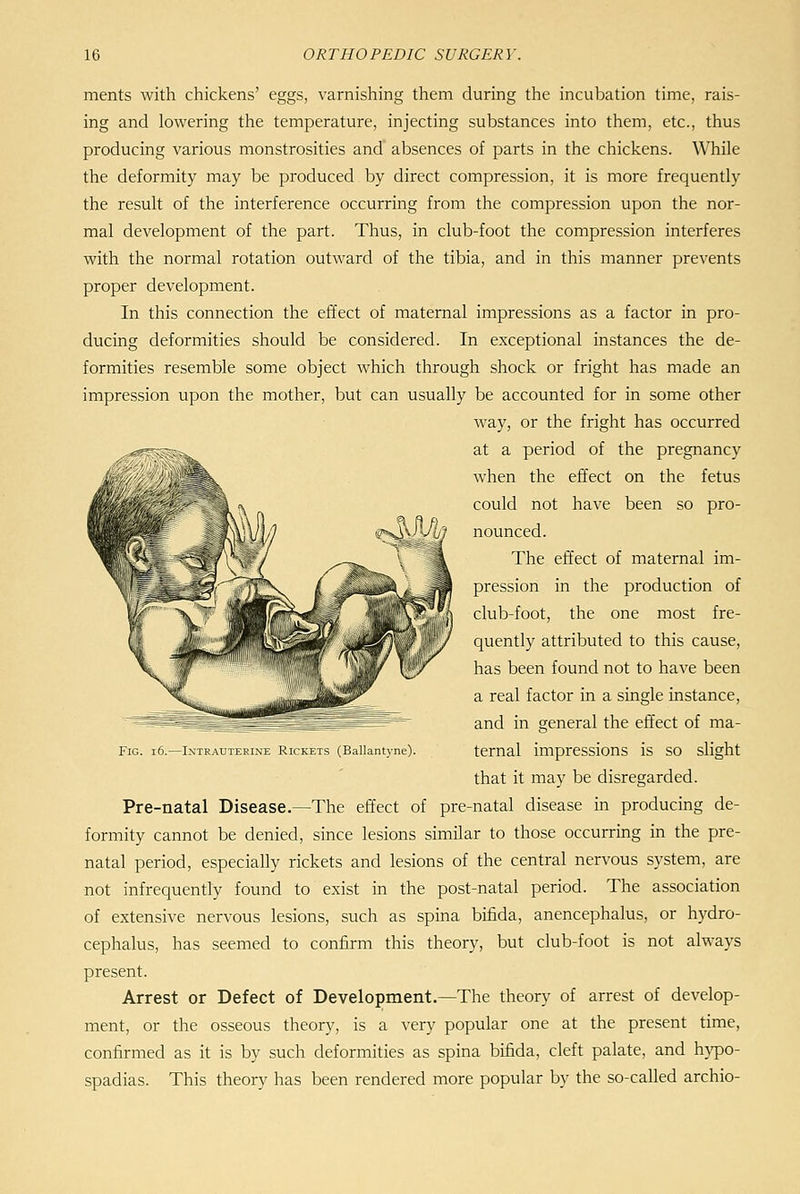 ments with chickens' eggs, varnishing them during the incubation time, rais- ing and lowering the temperature, injecting substances into them, etc., thus producing various monstrosities and absences of parts in the chickens. While the deformity may be produced by direct compression, it is more frequently the result of the interference occurring from the compression upon the nor- mal development of the part. Thus, in club-foot the compression interferes with the normal rotation outward of the tibia, and in this manner prevents proper development. In this connection the effect of maternal impressions as a factor in pro- ducing deformities should be considered. In exceptional instances the de- formities resemble some object which through shock or fright has made an impression upon the mother, but can usually be accounted for in some other way, or the fright has occurred at a period of the pregnancy when the effect on the fetus could not have been so pro- nounced. The effect of maternal im- pression in the production of club-foot, the one most fre- quently attributed to this cause, has been found not to have been a real factor in a single instance, and in general the effect of ma- ternal impressions is so slight that it may be disregarded. Pre-natal Disease.—The effect of pre-natal disease in producing de- formity cannot be denied, since lesions similar to those occurring in the pre- natal period, especially rickets and lesions of the central nervous system, are not infrequently found to exist in the post-natal period. The association of extensive nervous lesions, such as spina bifida, anencephalus, or hydro- cephalus, has seemed to confirm this theory, but club-foot is not always present. Arrest or Defect of Development.—The theory of arrest of develop- ment, or the osseous theory, is a very popular one at the present time, confirmed as it is by such deformities as spina bifida, cleft palate, and hypo- spadias. This theory has been rendered more popular by the so-called archio- FiG. i6.—Intrauterine Rickets (Ballantyne).