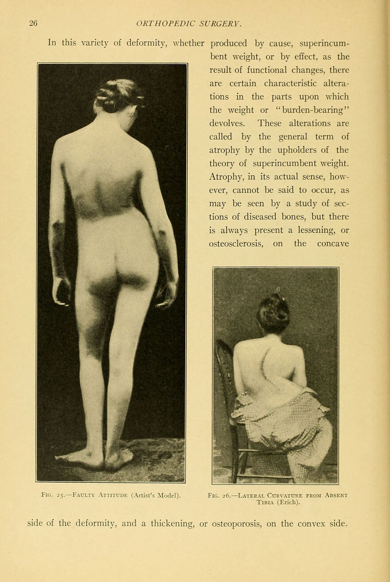 In this variety of deformity, wliether produced by cause, superincum- bent weight, or by effect, as the result of functional changes, there are certain characteristic altera- tions in the parts upon which the weight or burden-bearing devolves. These alterations are called by the general term of atrophy by the upholders of the theory of superincumbent weight. Atrophy, in its actual sense, how- ever, cannot be said to occur, as may be seen by a study of sec- tions of diseased bones, but there is always present a lessening, or osteosclerosis, on the concave Fig. 25.—Faulty .Attitude (.Artist's Model). Fig. 26.—Lateral Curvature frum Absent Tibia (Erich). side of the deformity, and a thickening, or osteoporosis, on the conve.K side.