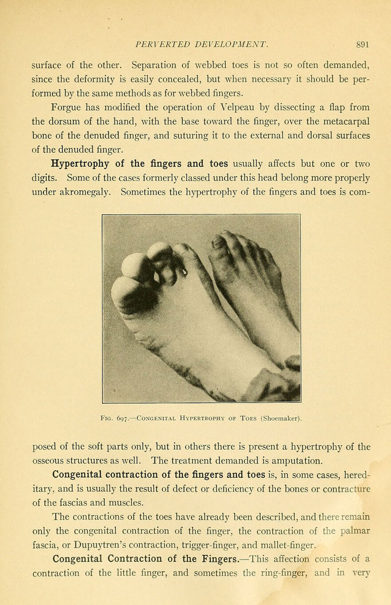 surface of the other. Separation of webbed toes is not so often demanded, since the deformity is easily concealed, but when necessary it should be per- formed by the same methods as for webbed fingers. Forgue has modified the operation of Velpeau by dissecting a flap from the dorsum of the hand, with the base toward the finger, over the metacarpal bone of the denuded finger, and suturing it to the external and dorsal surfaces of the denuded finger. Hypertrophy of the fingers and toes usually affects but one or two digits. Some of the cases formerly classed under this head belong more properly vmder akromegaly. Sometimes the hypertrophy of the fingers and toes is com- FiG. 697.—Congenital Hypertrophy of Toes (Shoemaker). posed of the soft parts only, but in others there is present a hypertrophy of the osseous structures as well. The treatment demanded is amputation. Congenital contraction of the fingers and toes is, in some cases, hered- itary, and is usually the result of defect or deficiency of the bones or contracture of the fascias and muscles. The contractions of the toes have already been described, and there remain only the congenital contraction of the finger, the contraction of the palmar fascia, or Dupuytren's contraction, trigger-finger, and mallet-finger. Congenital Contraction of the Fingers.—This affection consists of a contraction of the little finger, and sometimes the ring-finger, and in very