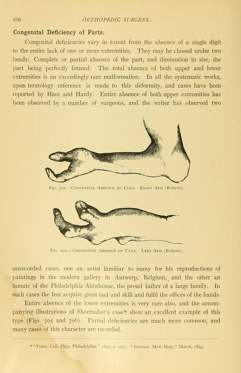 Congenital Deficiency of Parts. Congenital deficiencies vary in extent from the absence of a single digit to the entire lack of one or more extremities. They may be classed under two heads: Complete or partial absence of the part, and diminution in size, the part being perfectly formed. The total absence of both upper and lower extremities is an exceedingly rare malformation. In all the systematic works, upon teratology reference is made to this deformity, and cases have been reported by Hare and Hardy. Entire absence of both upper extremities has been observed by a number of surgeons, and the v^riter has observed two Fig. 701.—Congenital Absence of Ulna. Right Arm (Roberts). Fig. 702.—Congenital Absence of Ulna. Left Arm (Roberts). unrecorded cases, one an artist familiar to many for his reproductions of paintings in the modern gallery in Antwerp, Belgium, _ and the other an inmate of the Philadelphia Almshouse, the proud father of a large family. In such cases the feet acquire great tact and skUl and fulfil the offices of the hands. Entire absence of the lower extremities is very rare also, and the accom- panying illustrations of Shoemaker's case* show an excellent example of this type (Figs. 705 and 706). Partial deficiencies are much more common, and many cases of this character are recorded. * Trans. Coll. Phys. Philadelphia, iSgs, p. 191. Internal. Med. Mag., March, 1893.