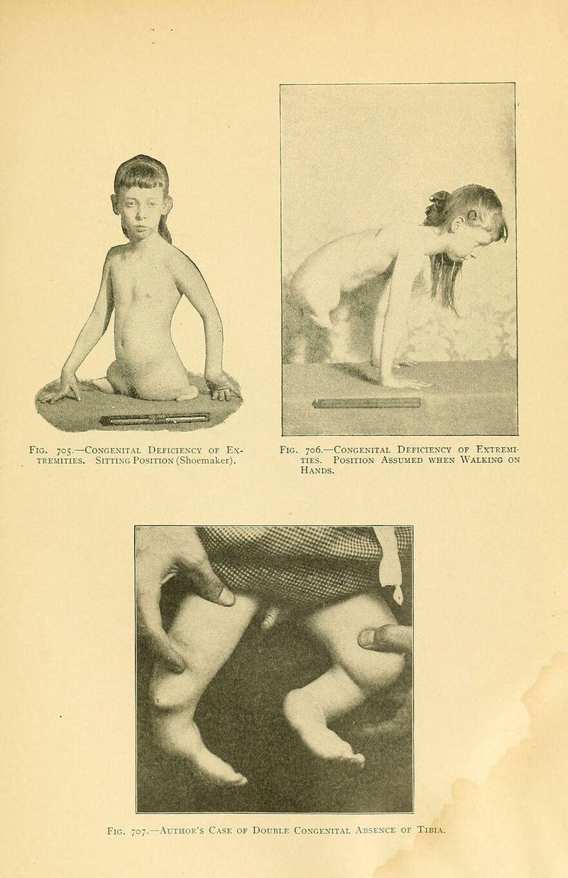 Fig. 705.—Congenital Deficiency of Ex- tremities. Sitting Position (Shoemaker). Fig. 706.—Congknital Deficiency of Extrem- TIES. Position Assumed when Walking on Hands. Fig. 707.—.Vuthor's Case of Double Congenit.al Absence of Tibia.