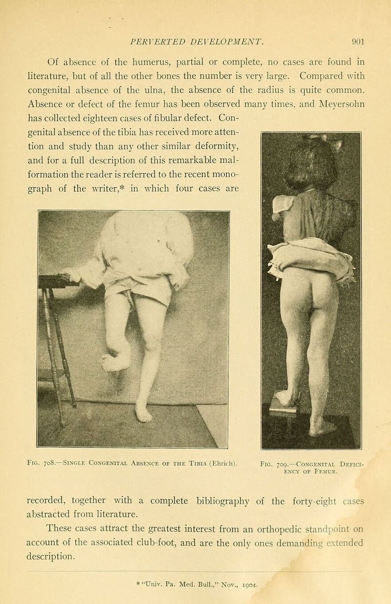 Of absence of the humerus, partial or complete, no cases are found in literature, but of all the other bones the number is very large. Compared with congenital absence of the ulna, the absence of the radius is quite common. Absence or defect of the femur has been observed many times, and Meyersohn has collected eighteen cases of fibular defect. Con- genital absence of the tibia has received more atten- tion and study than any other similar deformity, and for a full description of this remarkable mal- formation the reader is referred to the recent mono- graph of the writer,* in which four cases are Fig. 708.—Single Congenital Absence of the Tibia (Ehrich). Fig. yog.—Congenital Defici- ency OF Femur. recorded, together with a complete bibliography of the forty-eight cases abstracted from literature. These cases attract the greatest interest from an orthopedic standpoint on account of the associated club-foot, and are the only ones demanding extended description. * Univ. Pa. Med. Bull., Nov., 1904.