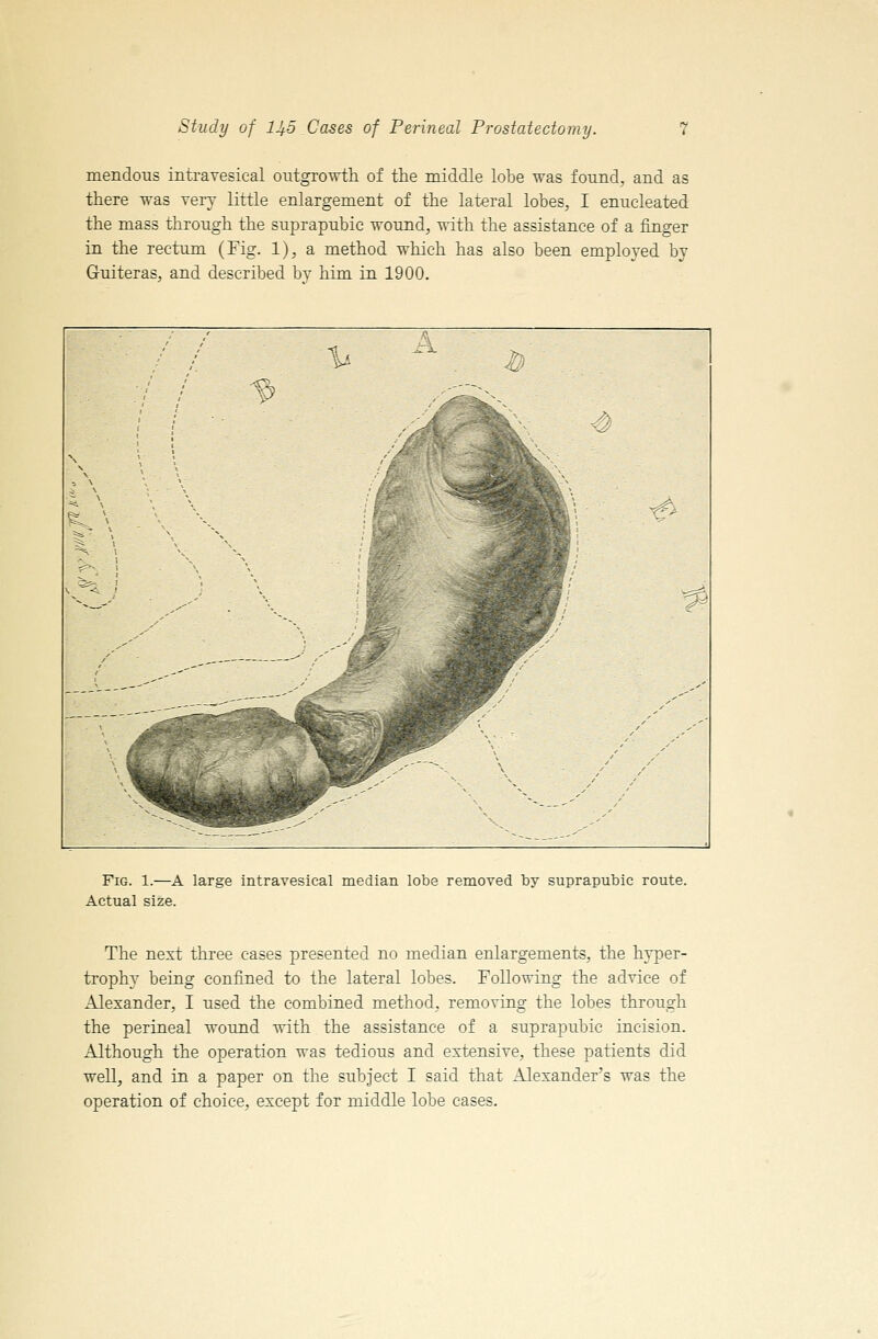 mendous intravesical outgrovrth of the middle lobe ^as found, and as there was Terr little enlargement of the lateral lobes, I enucleat-ed the mass through the suprapubic -wound, with the assistance of a finger in the rectum (Fig. 1), a method which has also been employed by Guiteras, and described bv him in 1900. Y^> 9^ Fig. 1.—A large intravesical median lobe removed by suprapubic route. Actual size. The next three cases presented no median enlargements, the hyper- trophy being confined to the lateral lobes. Following the advice of Alexander, I used the combined method, removing the lobes through the perineal wound with the assistance of a suprapubic incision, illthough the operation was tedious and extensive, these patients did well, and in a paper on the subject I said that Alexanders was the operation of choice, except for middle lobe cases.