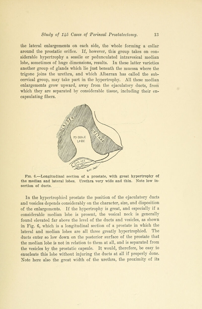 the lateral enlargements on each side, the whole forming a collar around the prostatic orifice. If, however, this group takes on con- siderable hypertrophy a sessile or pedunculated intravesical median lobe, sometimes of huge dimensions, results. In these latter varieties another group of glands which lie just beneath the mucosa where the trigone joins the urethra, and which Albarran has called the sub- cervical group, may take part in the hypertrophy. All these median enlargements grow upward, away from the ejaculatory ducts, from which they are separated by considerable tissue, including their en- capsulating fibers. Fig, 6.—Longitudinal section of a prostate, with great hypertrophy of the median and lateral lobes. Urethra very wide and thin. Note low in- sertion of ducts. In the hypertrophied prostate the position of the ejaculatory ducts and vesicles depends considerably on the character, size, and disposition of the enlargements. If the hypertrophy is great, and especially if a considerable median lobe is present, the vesical neck is generally found elevated far above the level of the ducts and vesicles, as shown in Fig. 6, which is a longitudinal section of a prostate in which the lateral and median lobes are all three greatly hypertrophied. The ducts enter so low down on the posterior surface of the prostate that the median lobe is not in relation to them at all, and is separated from the vesicles by the prostatic capsule. It would, therefore, be easy to enucleate this lobe without injuring the ducts at all if properly done. Note here also the great width of the urethra, the proximity of its